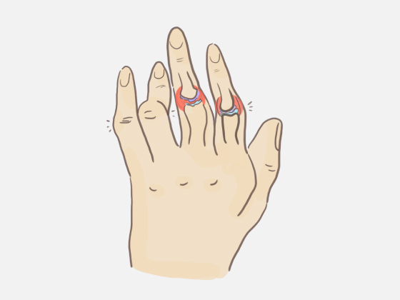 류마티스관절염 이미지