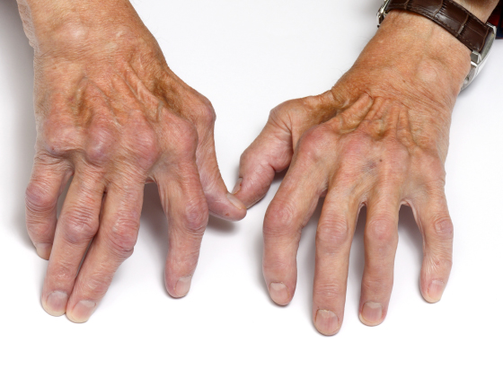 관절 외 증상 이미지