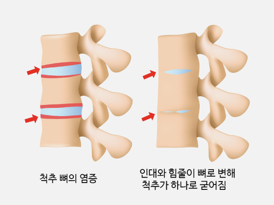 강직성 척추염 이미지