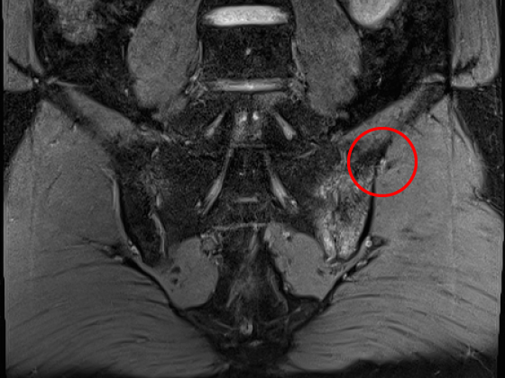 단순 X-ray 천장관절염